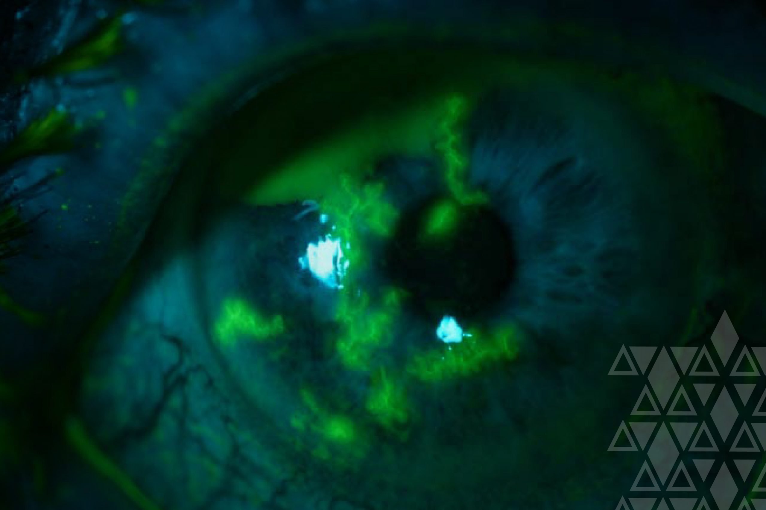 Saiba o que é ceratite ocular Via Oftalmocenter Saiba o que é ceratite ocular Via Oftalmocenter